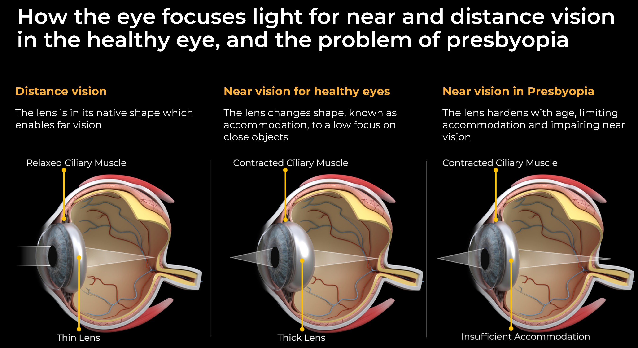 How the eye focuses light for near and distance vision in the healthy eye.jpg
